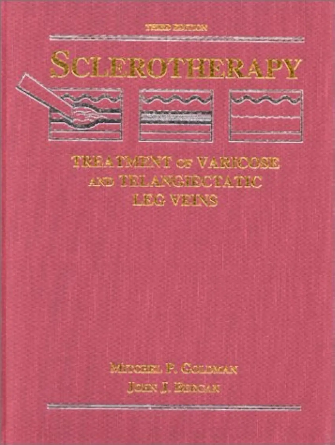 Sclerotherapy: Treatment Of Varicose And Telangiectatic Leg Veins Goldman, Mitchel P. And Bergan, John J. 1